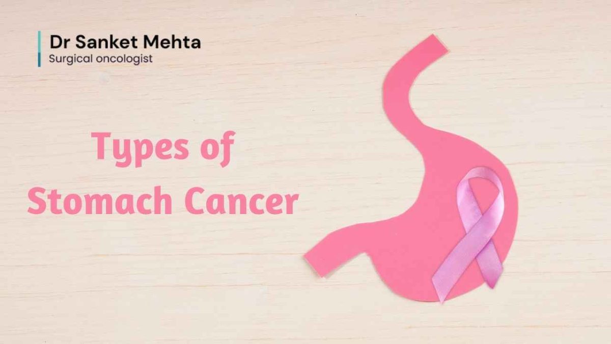 types-of-stomach-cancer